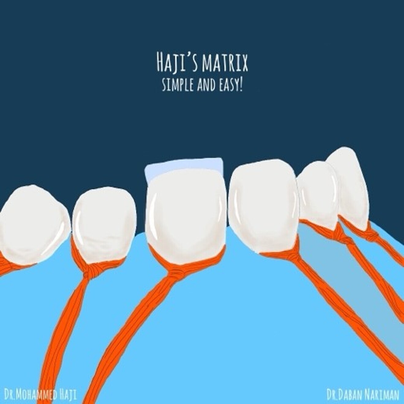 Fig. 1d: Palatal shell created based on the predetermined shape  and size of the tooth.