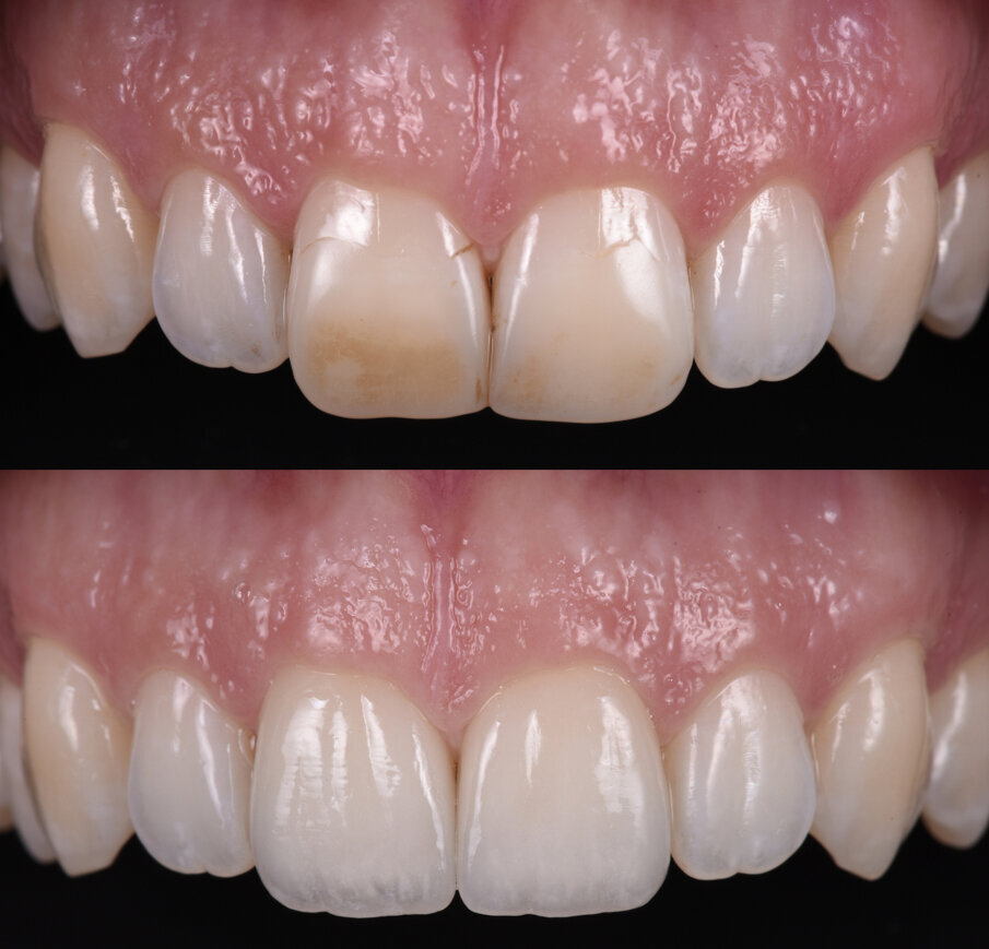 Figs. 31a & b: Pre-op and post-op photographs of restorations #11 and 21.