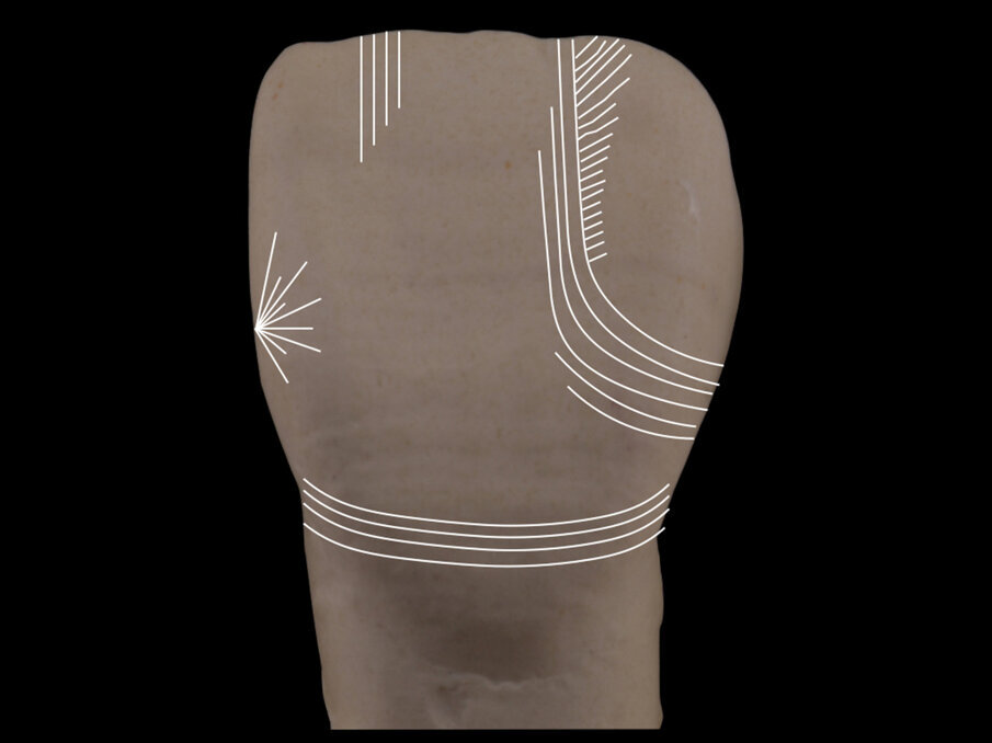 Fig. 11: Rounding the right lobe of the tooth by marking the texture surface with curved lines that become smaller towards the cervical third of the tooth.