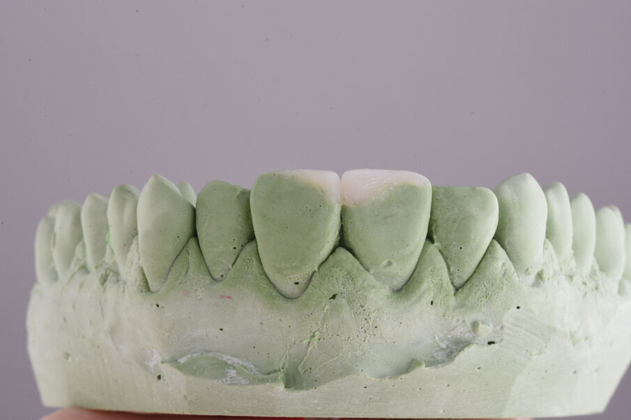 Sl. 5b: Wax up buduće restauracije