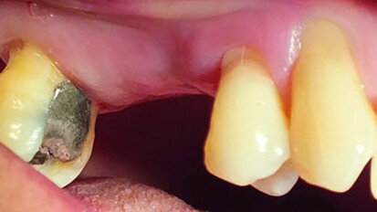 Dynamic navigation for reliable and predictable flapless implant placement Dynamic navigation for reliable and predictable flapless implant placement