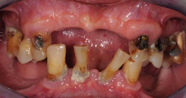 Impianti extra-corti e carico  immediato: un case-report