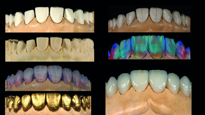 Fig. 13: Analogue workflow (refractory dies, built-up veneers, adjustments, staining/glazing).