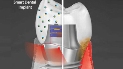 Разработват антибактериален интелигентен дентален имплант, който използва фототерапия