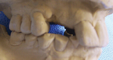 Lom implantata: Osvrt na fizičke mehanizme kliničkog neuspeha