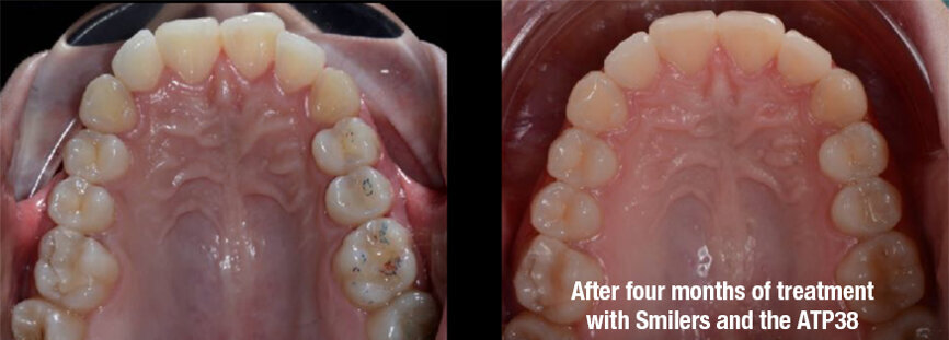 Fig. 3: Before (left) and after (right). The case was solved over four months with 16 clear aligners
(Smilers) and photobiomodulation therapy (with the ATP38), applied every week for six minutes every time aligners were changed.