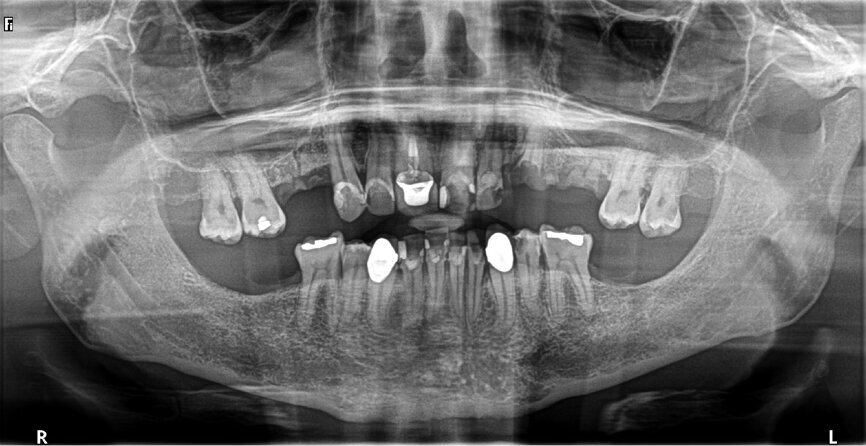 Fig. 5: Pre-op panoramic view.