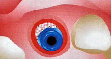 Impianti post estrattivi in siti infetti: un approccio clinico predicibile