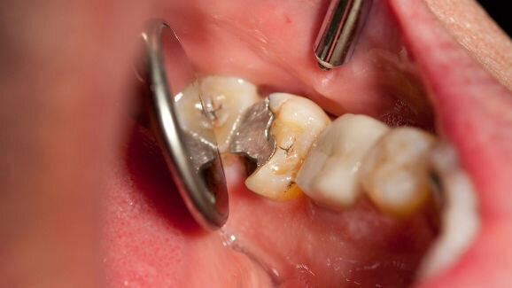 Australian Dental Industry Association advocates ratification of mercury treaty