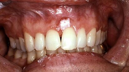 New gene test enables early oral cancer detection