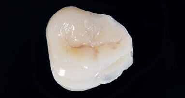 Funkční, anatomická a estetická harmonie s novým kompozitem Enamel Plus HRi Bio Function