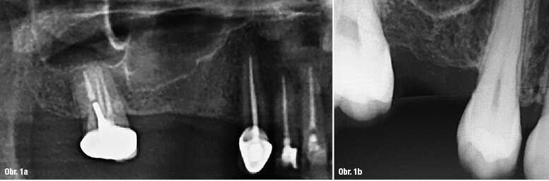 Obr. 1a: RTG snímek bezzubého prostoru znázorňující pneumatizaci čelistní dutiny  Obr. 1b: Schéma představující možný klinický vývoj u pacienta a také možnou fluktuaci reziduální výšky alveolárního hřebene. V požadovaném místě implantace, k nahrazení zubu 16, byly naměřeny 4 mm.