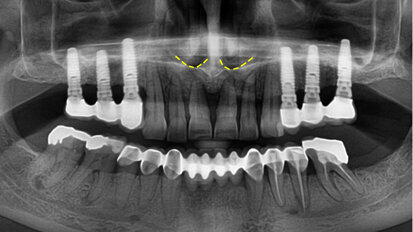 Kdy parodontolog předá pacienta implantologovi?