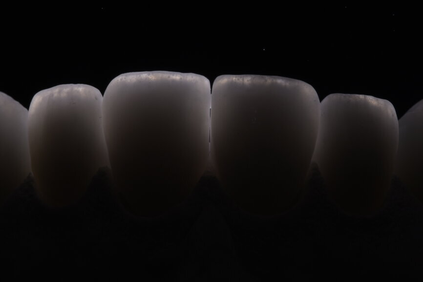 Fig. 77: Ceramic opalescence and incisal effects.