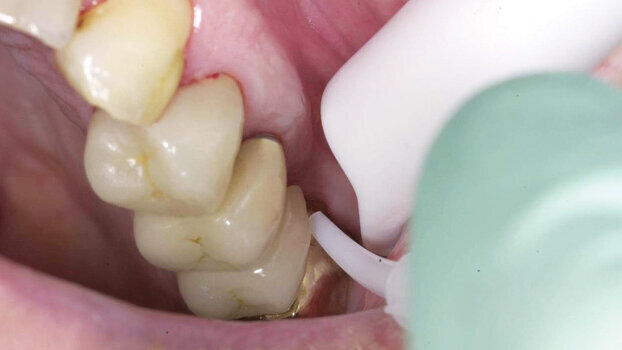 An introduction to lasers in dental hygiene