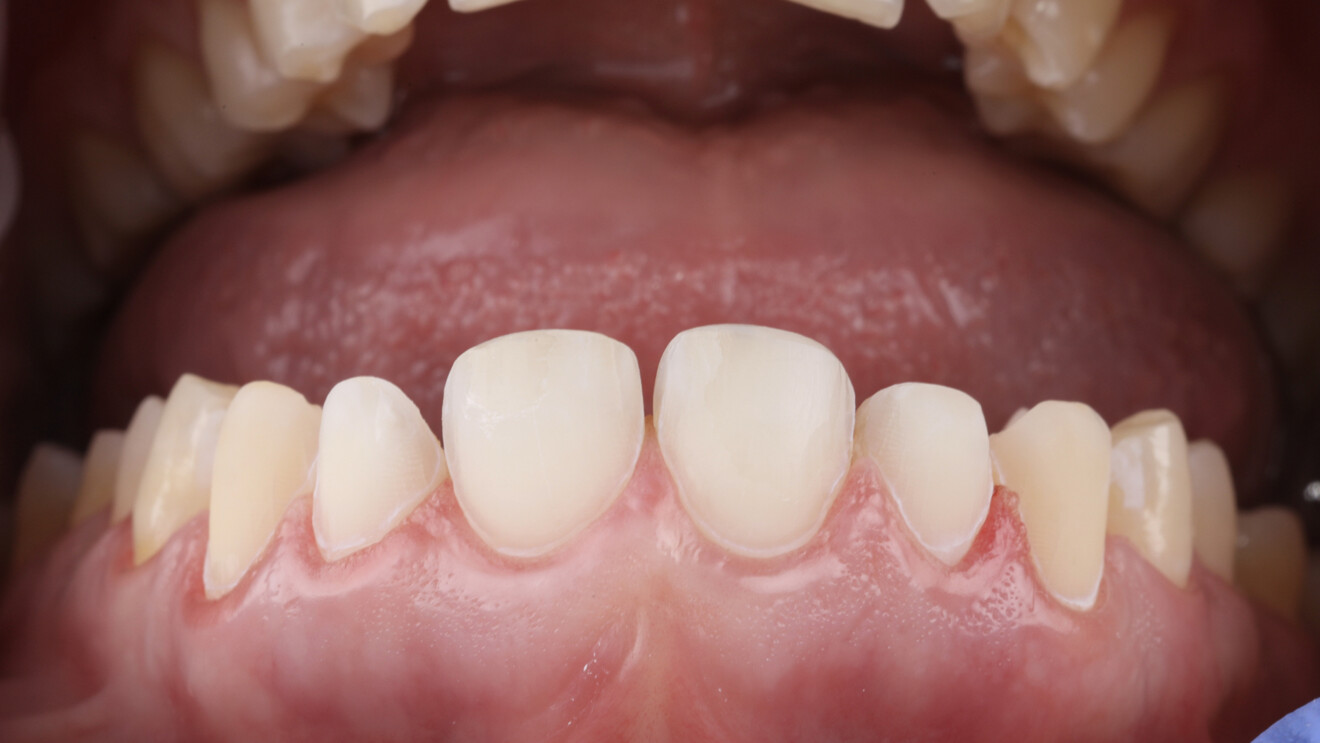 Fig. 6b: Tooth surfaces after enamel conditioning.
