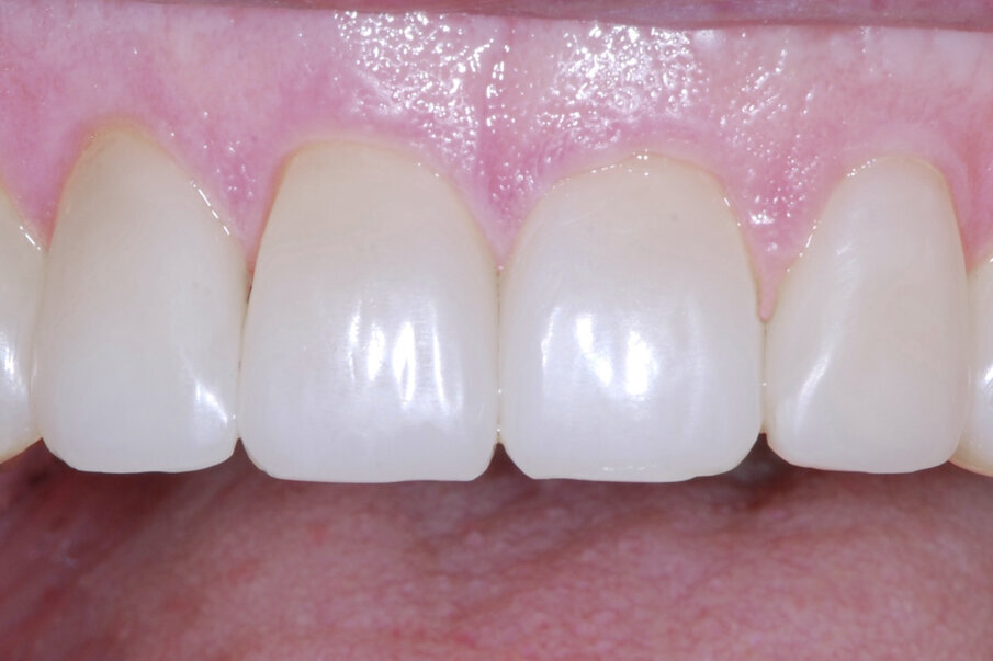 Fig. 1: Silky gloss of classic composite shells