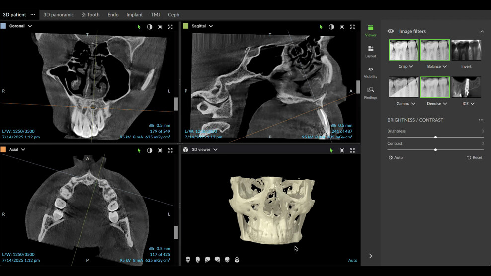 Fig. 6: High-definition CBCT scan with the DEXIS OP 3D showing fibrous tissue above the root.