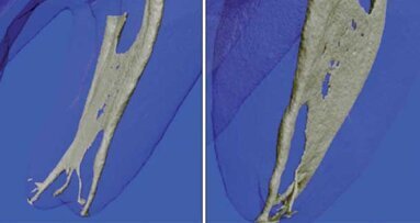 Endodontic irrigants and irrigant delivery systems