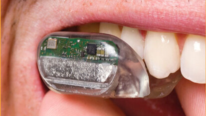 Neuartiges Hörgerät wird im Mund platziert Neuartiges Hörgerät wird im Mund platziert