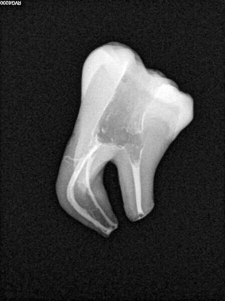 Fig. 4: Post-op radiograph of a mandibular molar.