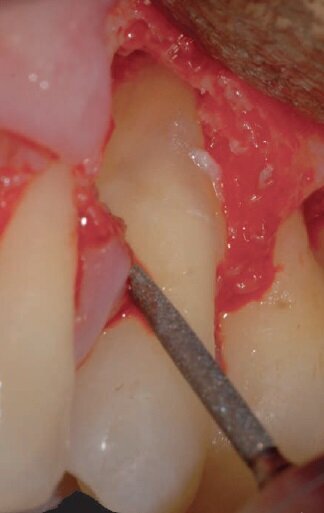Fig. 5 - Rimozione delle incongruenze anatomiche (perle dello smalto) tramite strumenti rotanti.