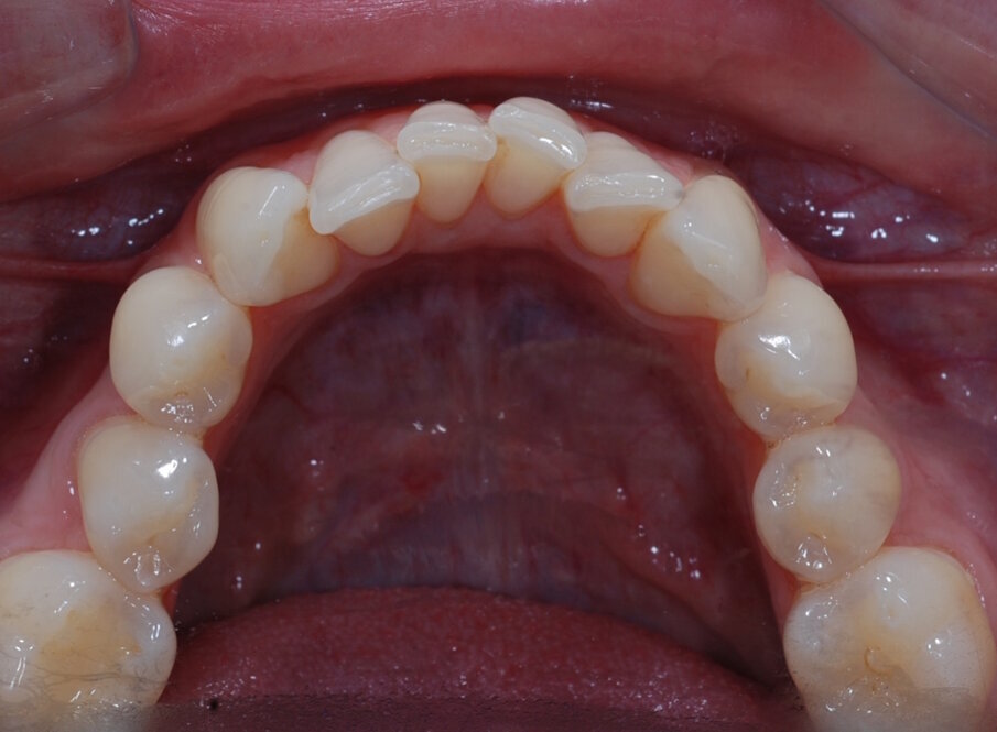 Fig. 7: Pre treatment lower occlusal