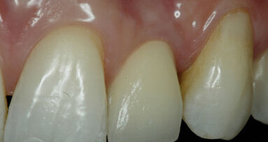 New grafting procedure for oral implantation