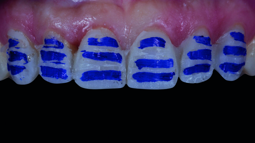 Fig. 9a : Préparation selon le mock-up. 