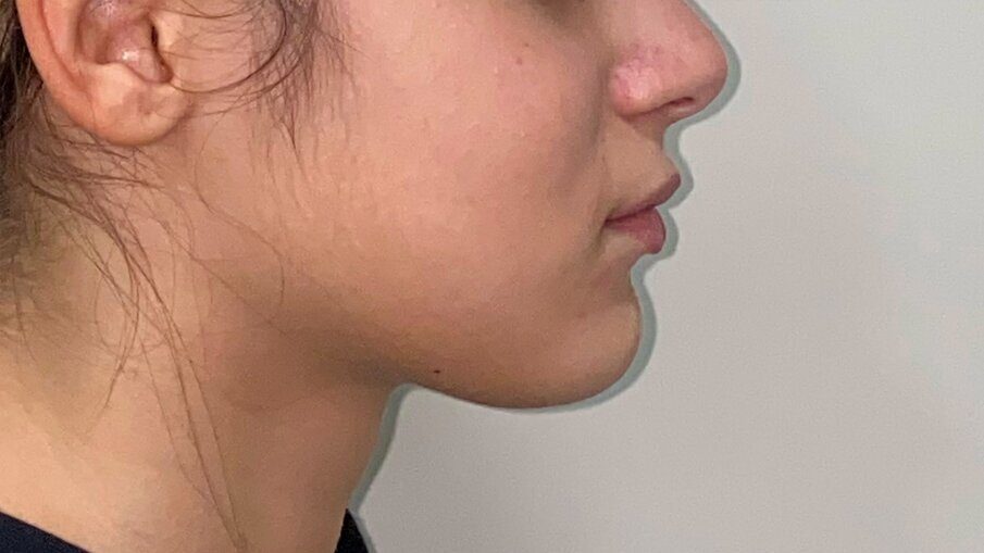 Fig. 3_Profilo pre-trattamento.