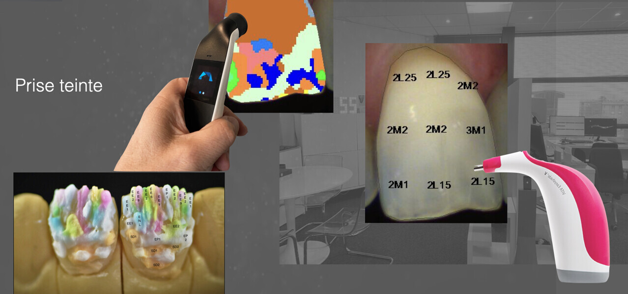 Fig. 6 : Prise de teinte avec spectrophotomètre avec Vita Easy-shade (VITA Zahnfabrik) ou Cobra (Borea).