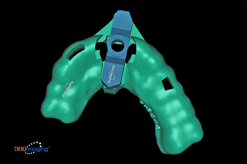 Fig. 15b: Separate inserts were fabricated for the initial drill guide to reach the root apex to accommodate sectioning, followed by a second guide for final osteotomy drilling and implant placement.