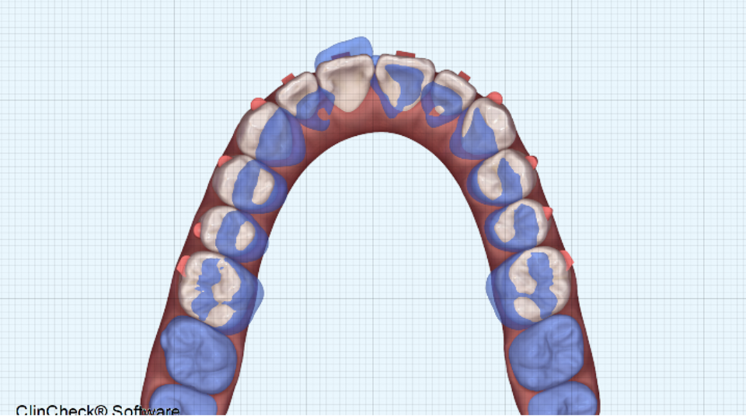 Fig. 22: Orthodontic digital simulation using Invisalign software to show the pre-treatment position (blue) and the predicted result after treatment (white).