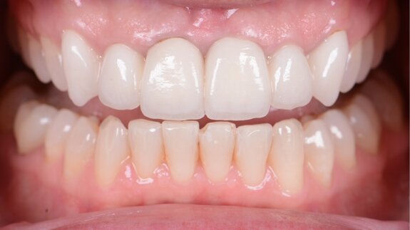 A bright new smile with KATANA Zirconia YML