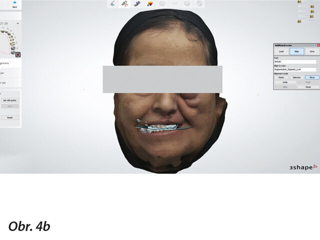 Sloučení digitálních dat pomocí softwaru Dental System.