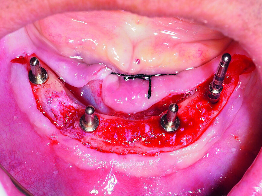Fig. 1: Implant positioning should be as parallel as possible with regard to the future occlusal plane.