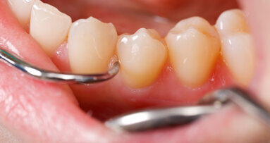 Forscher identifizieren Parodontitis-Bakterium