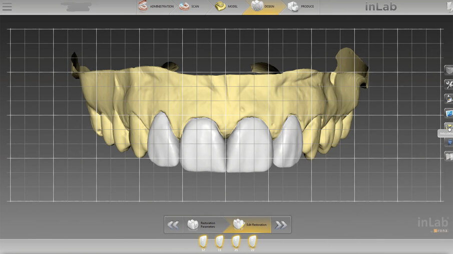 Fig. 5: Mockup-design of the veneers in the inLab SW 19.