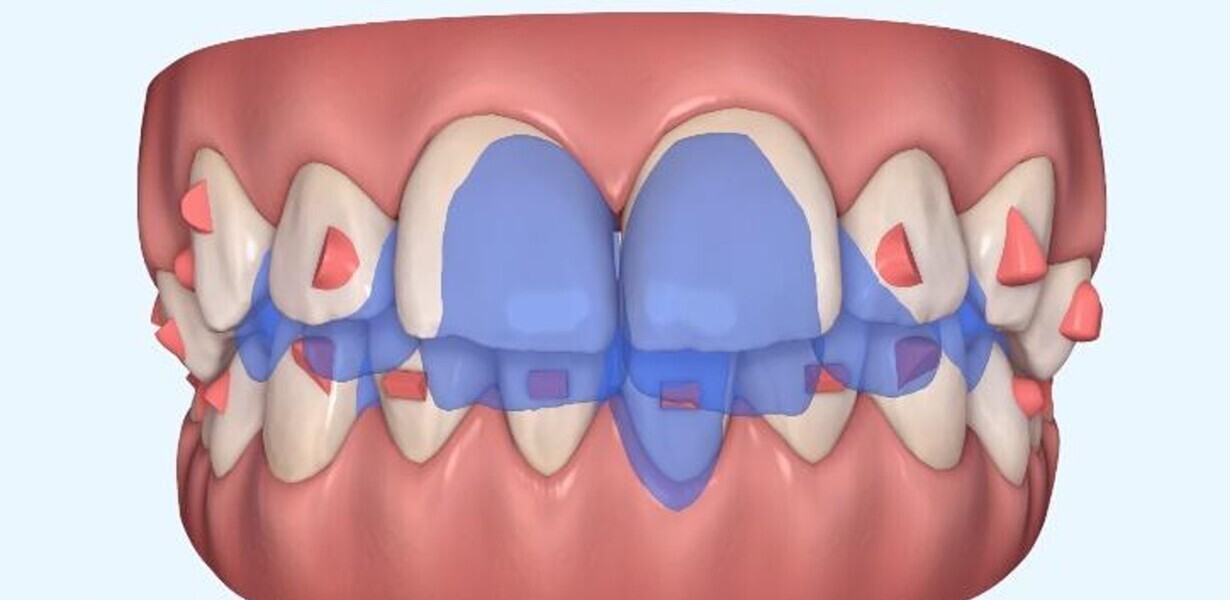 Fig. 15: Orthodontic digital simulation using Invisalign software to show the pre-treatment position (blue) and the predicted result after treatment (white).