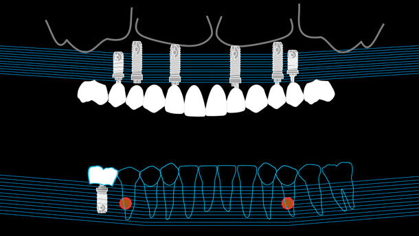 Riabilitazione implanto-protesica di un caso complesso alla luce delle nuove tecnologie: un caso clinico
