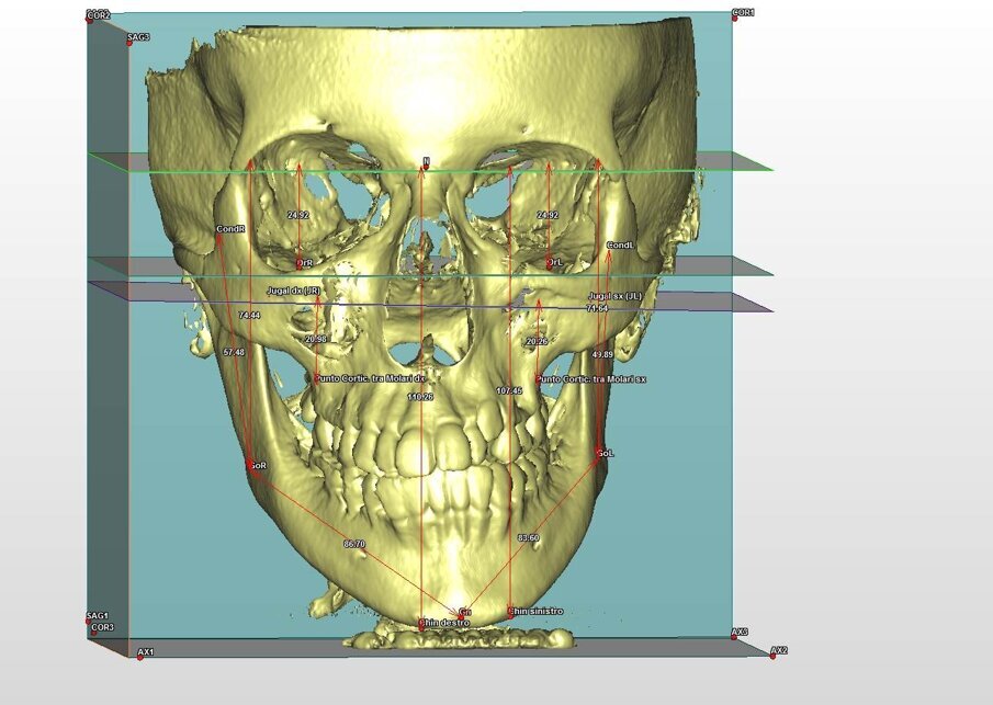 Fig. 1_Analisi cefalometrica 3D per lo studio della simmetria scheletrica. 