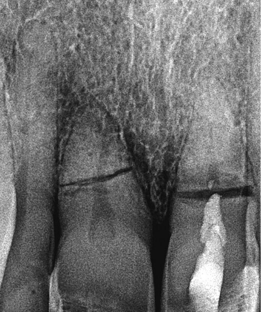 Slika 3. Stanje nakon punjenja korijenskog kanala do frakture s MTA-om na zubu 21