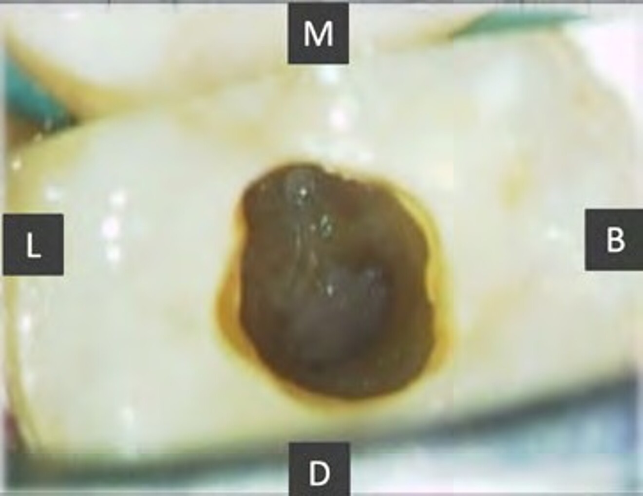 Fig. 1a: Preoperative microscopic view of the pulp chamber showing a separated endodontic instrument obstructing the canal orifice.