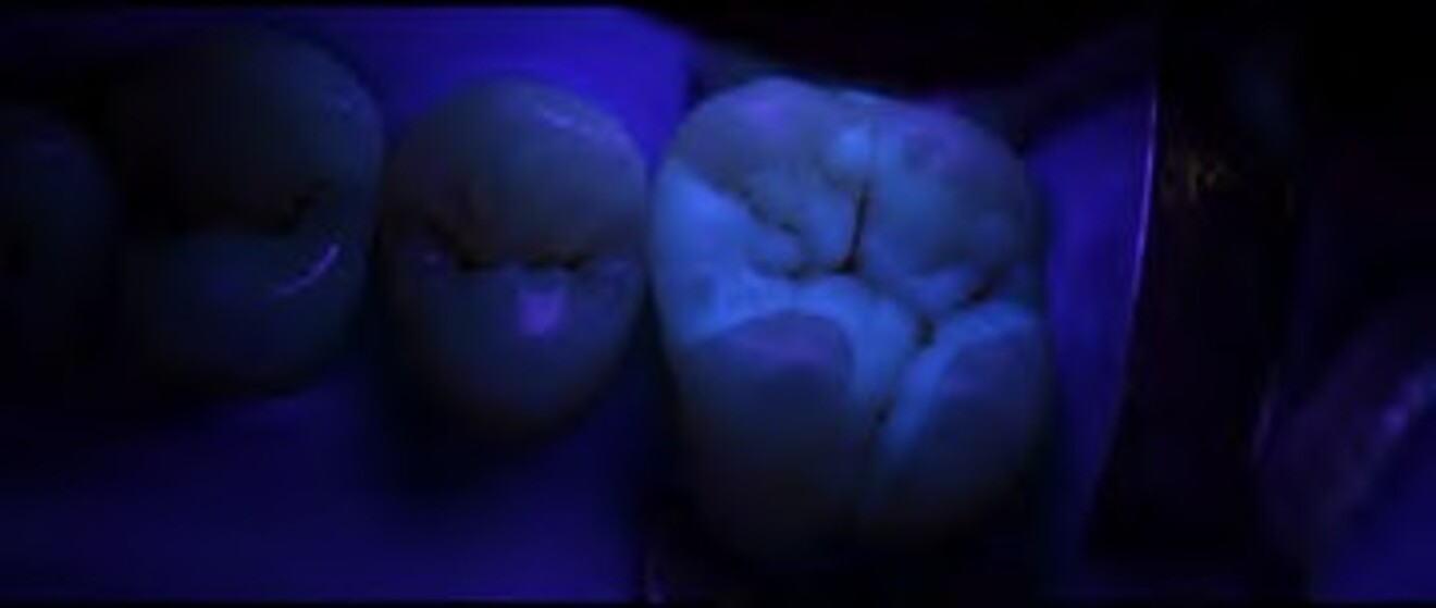 Fig. 3e: Fluorescence evaluation under ultraviolet illumination demonstrating the optical properties and aesthetic blending of the composite restorations  with the natural tooth structure. 