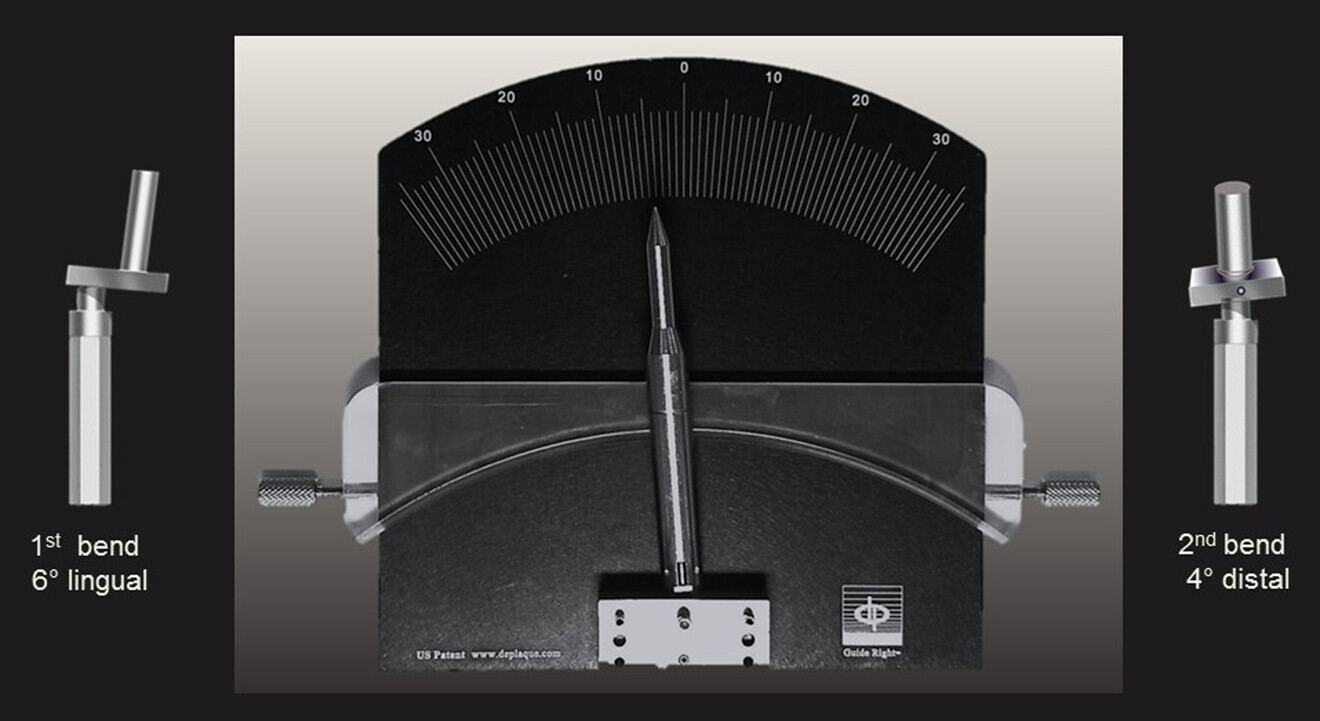 Fig. 13: Second angle correction of the modied offset guide post 4° to the distal aspect.