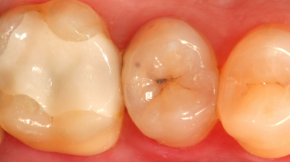 Una nueva técnica para eliminar la caries