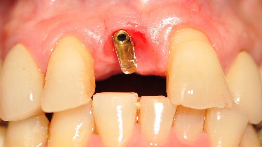 Impianti e monconi di piccolo diametro per la sostituzione di elementi in zona estetica