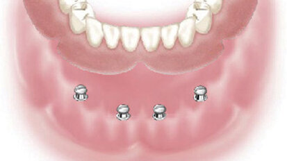 Henry Schein to distribute Dentatus