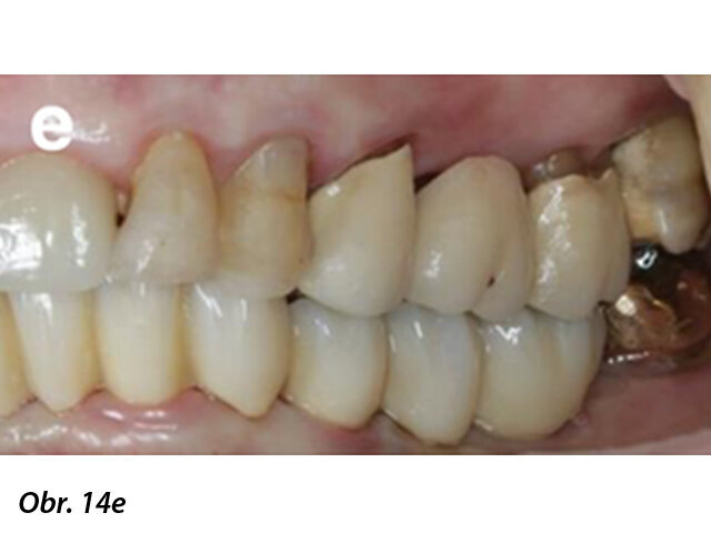 Zdravý stav periimplantátové sliznice a finální CAD/CAM náhrada bezprostředně po nasazení pacientce.