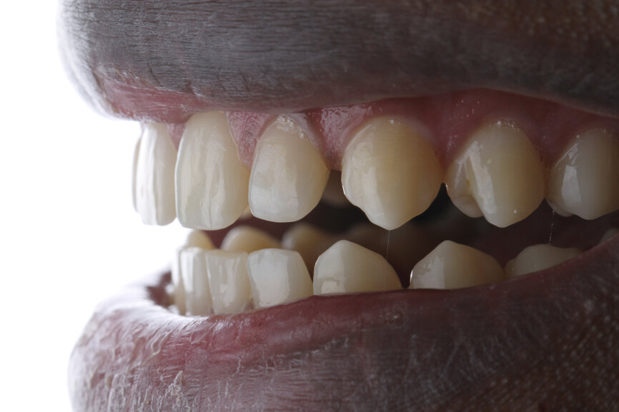 Fig. 9: Initial situation on smiling, lateral and frontal views.